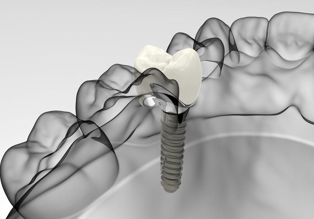 dental implant