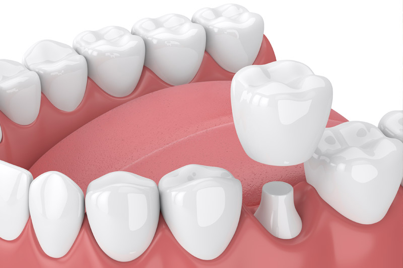 Dental Crowns in Cape Coral