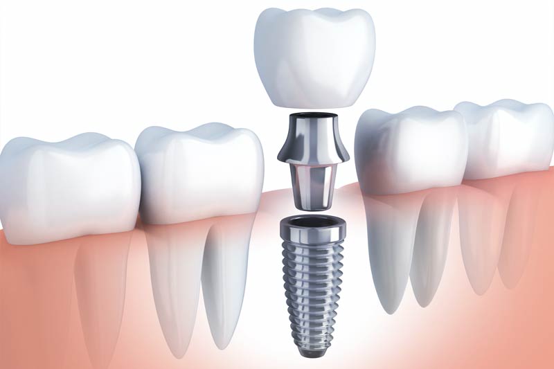 Implants Dentist in Cape Coral