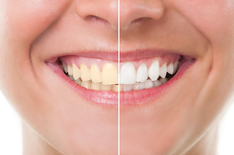 Teeth Whitening in Cape Coral