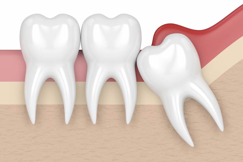 Wisdom Tooth Removal in Cape Coral